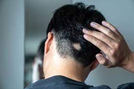 Haarverlies bestrijden met effectieve alopecia pillen