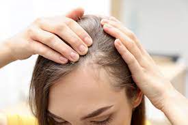 Alopecia Therapie: Herwinnen van Haarvertrouwen met Effectieve Behandelingen