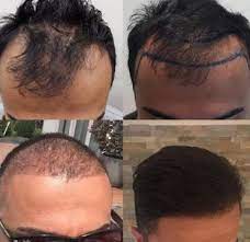 Effectieve haarverlies behandelingen voor mannen: Herstel jouw haardos en zelfvertrouwen