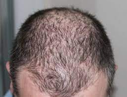Haarverlies preventie: Tips en advies om haaruitval te voorkomen