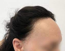 Haarverlies bij vrouwen: Oorzaken, behandeling en zelfzorgtips voor gezonde haargroei