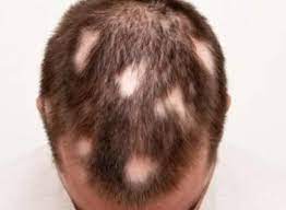 Natuurlijke Alopecia Behandeling: Terug naar de Essentie van Haarherstel