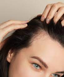 Persoonlijke Alopecia Zorg: Op Maat Gemaakte Behandelingen voor Haarverlies