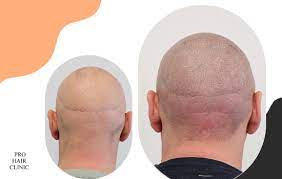 Veilige Alopecia Medicatie: Een Betrouwbare Oplossing voor Haarverlies