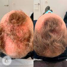 Effectieve haarverlies behandelingen: herstel uw haargroei en zelfvertrouwen