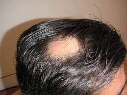 Alopecia en Haaruitval: Mogelijke Oplossingen en Behandelingen