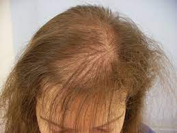Diffuus haarverlies bij vrouwen: Oorzaken, Behandeling en Oplossingen