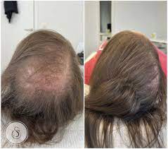 Behandeling van Haaruitval bij Vrouwen: Effectieve Oplossingen voor Haarverlies