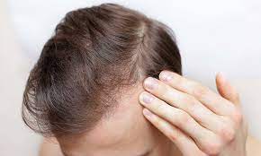 Het Beste Middel Tegen Haaruitval bij Mannen: Effectieve Oplossingen voor Haarverlies
