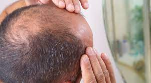Haarverlies bij mannen: Oorzaken en Behandelingen