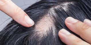Effectieve behandelingen voor haaruitval en dun haar: Ontdek de oplossingen