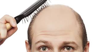 Effectieve Middelen tegen Kaalheid bij Mannen: Oplossingen voor Haarverlies