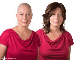 Haaruitval en Chemotherapie: Wat je moet weten
