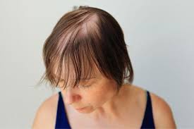 Behandeling van Haaruitval en Kale Plekken bij Vrouwen: Effectieve Oplossingen voor Haarverlies
