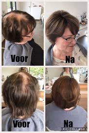 Haaruitval bij vrouwen: De invloed van hormonen op haarverlies