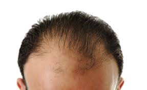 Behandeling van haaruitval met Finasteride 5 mg