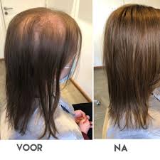 Oplossingen voor haarverlies bij vrouwen: Effectieve behandelingen en advies