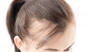 Behandeling van Alopecia Androgenetica: Advies van Thuisarts