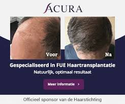 Behandeling van haaruitval met lasertherapie: een effectieve oplossing