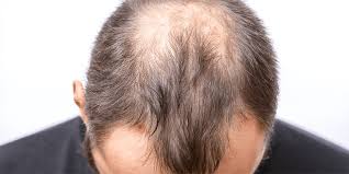 Behandeling van Haaruitval: Alles over Alopecia Androgenetica