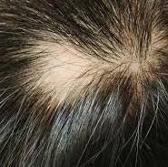 Hoe om te gaan met Alopecia: Oorzaken, Symptomen en Behandeling