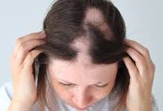 Behandeling van Alopecia Areata: Oplossingen voor Haarverlies