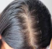 Alles wat u moet weten over androgenetica: oorzaken, symptomen en behandelingen