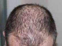 Effectieve Behandeling met Bewezen Haargroeimiddelen voor Gezonder Haar