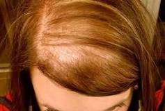 Alles over Alopecia Diffusa: Oorzaken, Symptomen en Behandelingen
