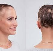 Alopecia en Erfelijkheid: Wat is de Rol van Genetica bij Haaruitval?