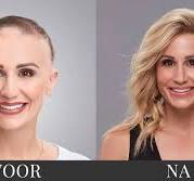 Alles wat je moet weten over de alopecia haarziekte