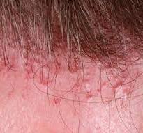 Alles wat u moet weten over frontale alopecia: Symptomen, Oorzaken en Behandeling