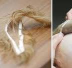 Frontale Fibroserende Alopecia Haarstuk: Een Oplossing voor Haarverlies