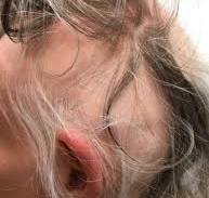 Alles wat u moet weten over haarziekte: Oorzaken, Symptomen en Behandeling