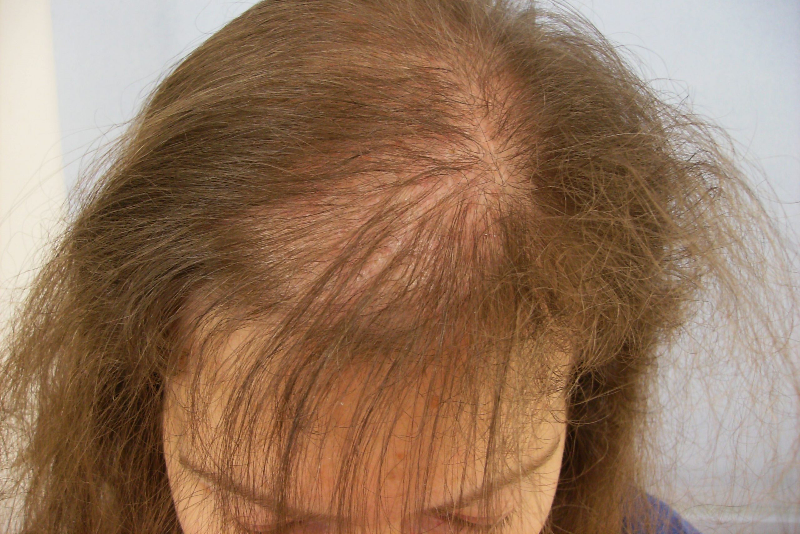 Alles over Alopecia: Haarverlies en Haarherstel Explained