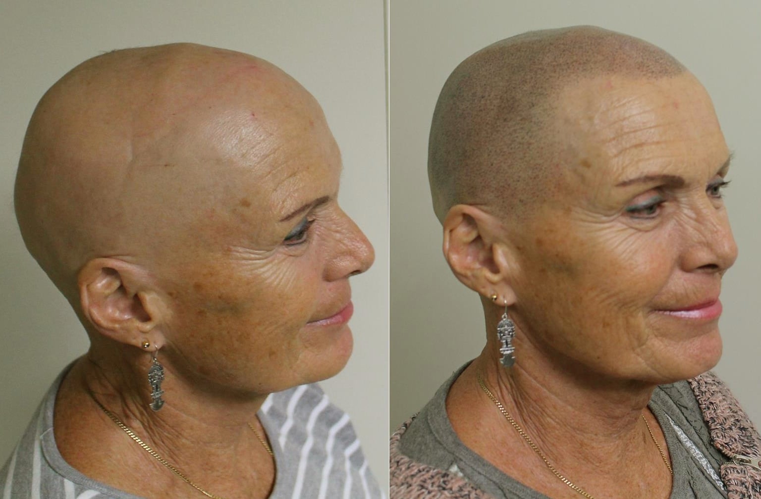 Behandeling voor Alopecia Universalis: Hoop voor Totale Haaruitval