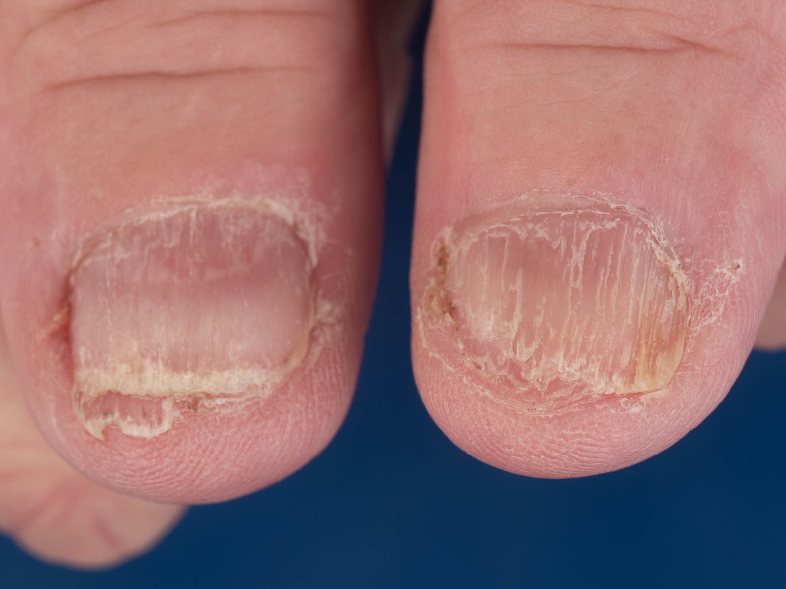 De Oorzaak van Alopecia Universalis: Een Diepgaande Analyse