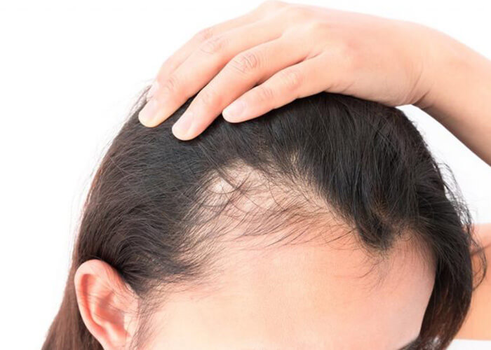 Effectiviteit van Bloedplasma Therapie bij Haaruitval: Een Innovatieve Behandelingsoptie