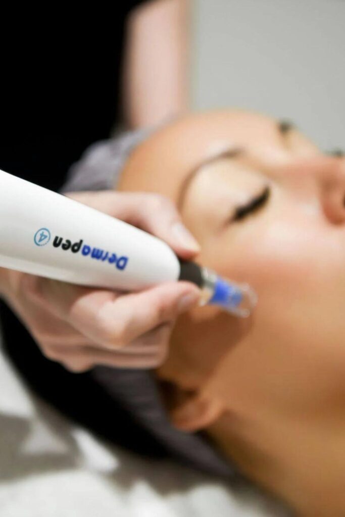 Dermapen: Effectieve behandeling tegen haaruitval