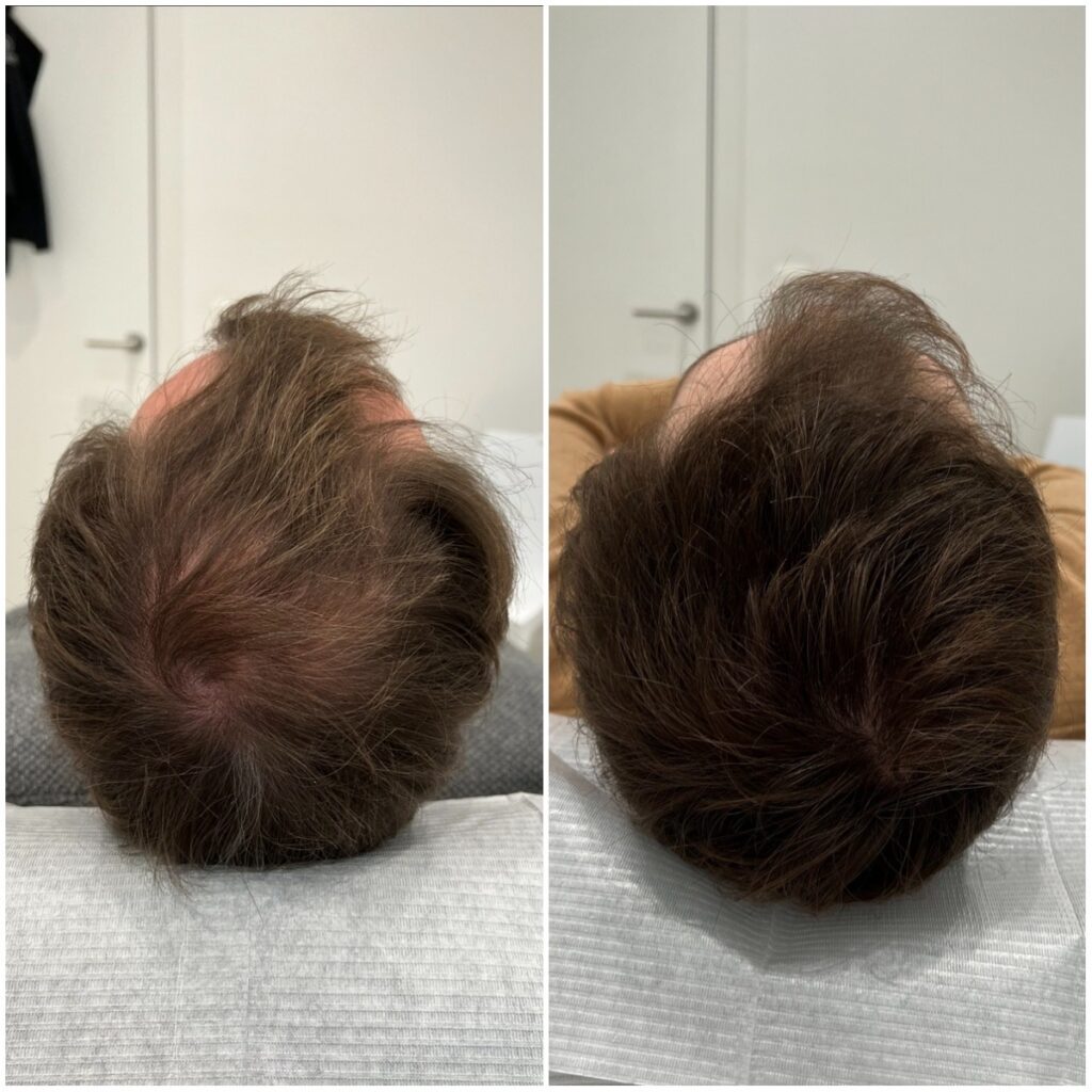 De Impact van Extreme Stress op Haaruitval: Een Diepgaande Analyse