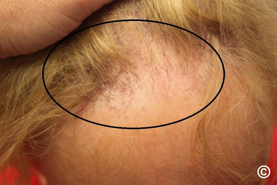 Fibroserende Alopecia: Symptomen, Oorzaken en Behandeling van Haarverlies