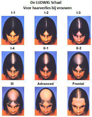 Het verband tussen haarverlies en stress: een diepgaande analyse