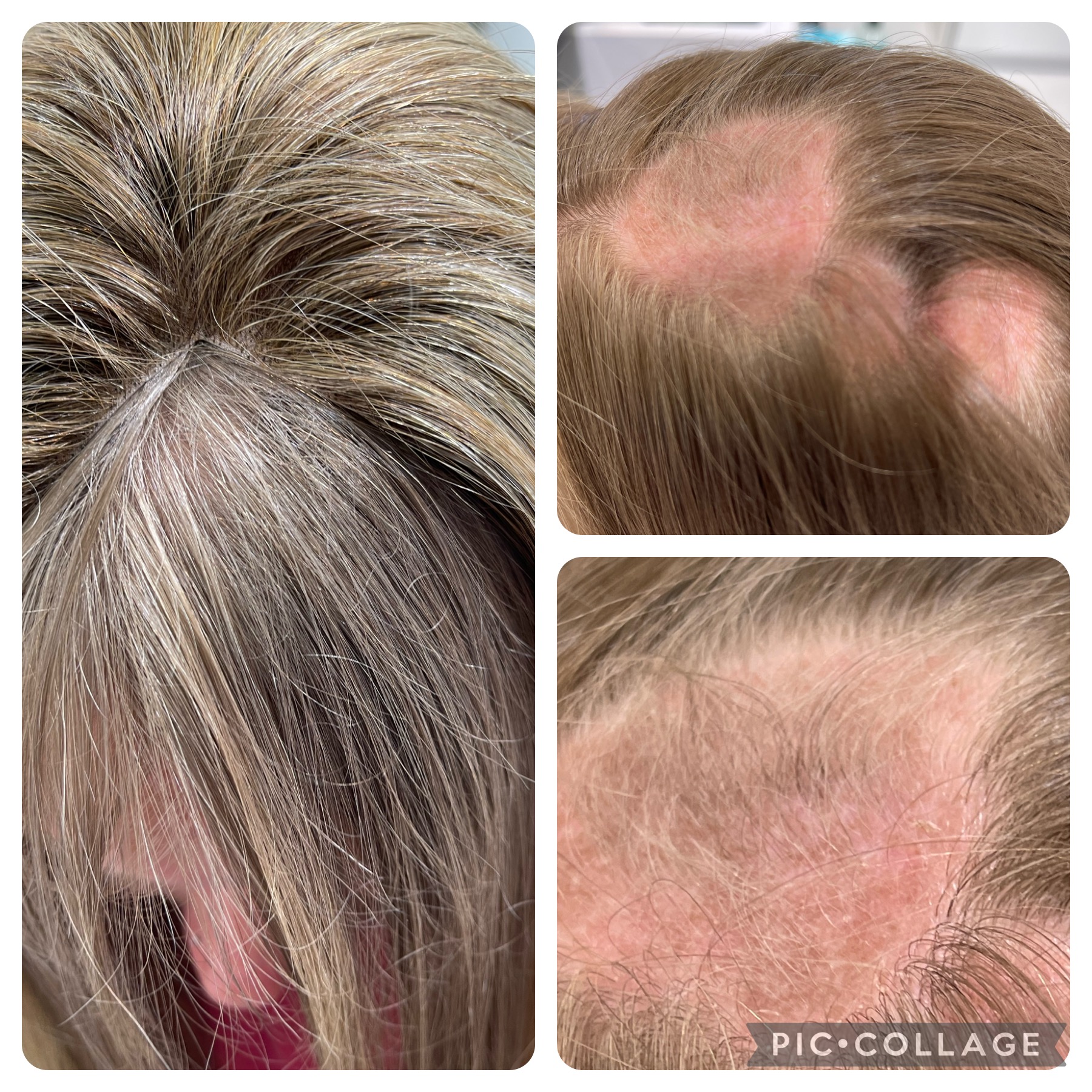 Haaruitval bij bestraling van het hoofd: Wat u moet weten