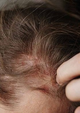 Haaruitval bij Kammen: Feiten en Tips om Haarverlies te Voorkomen