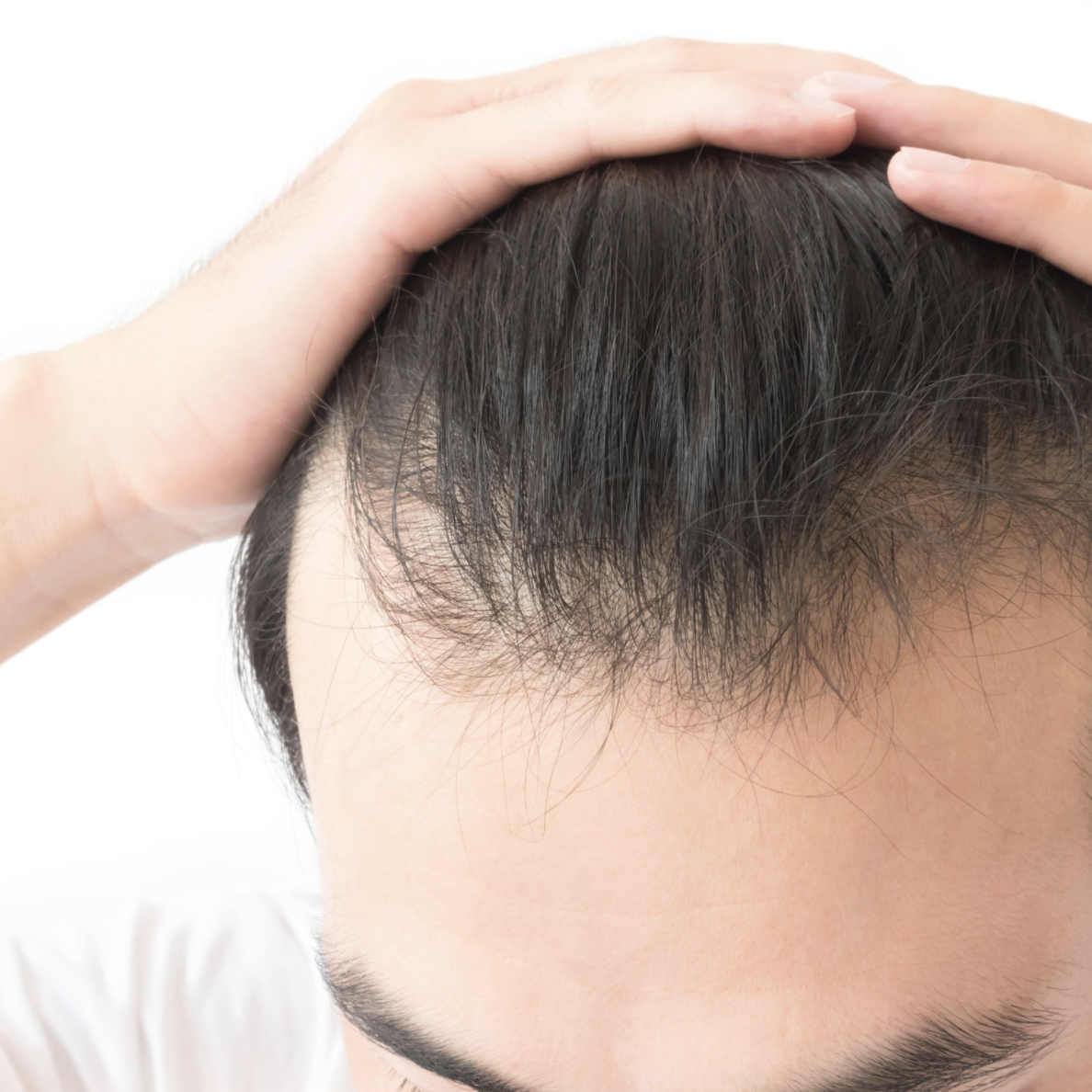 Alles over haaruitval bovenop het hoofd: Oorzaken en Behandelingen