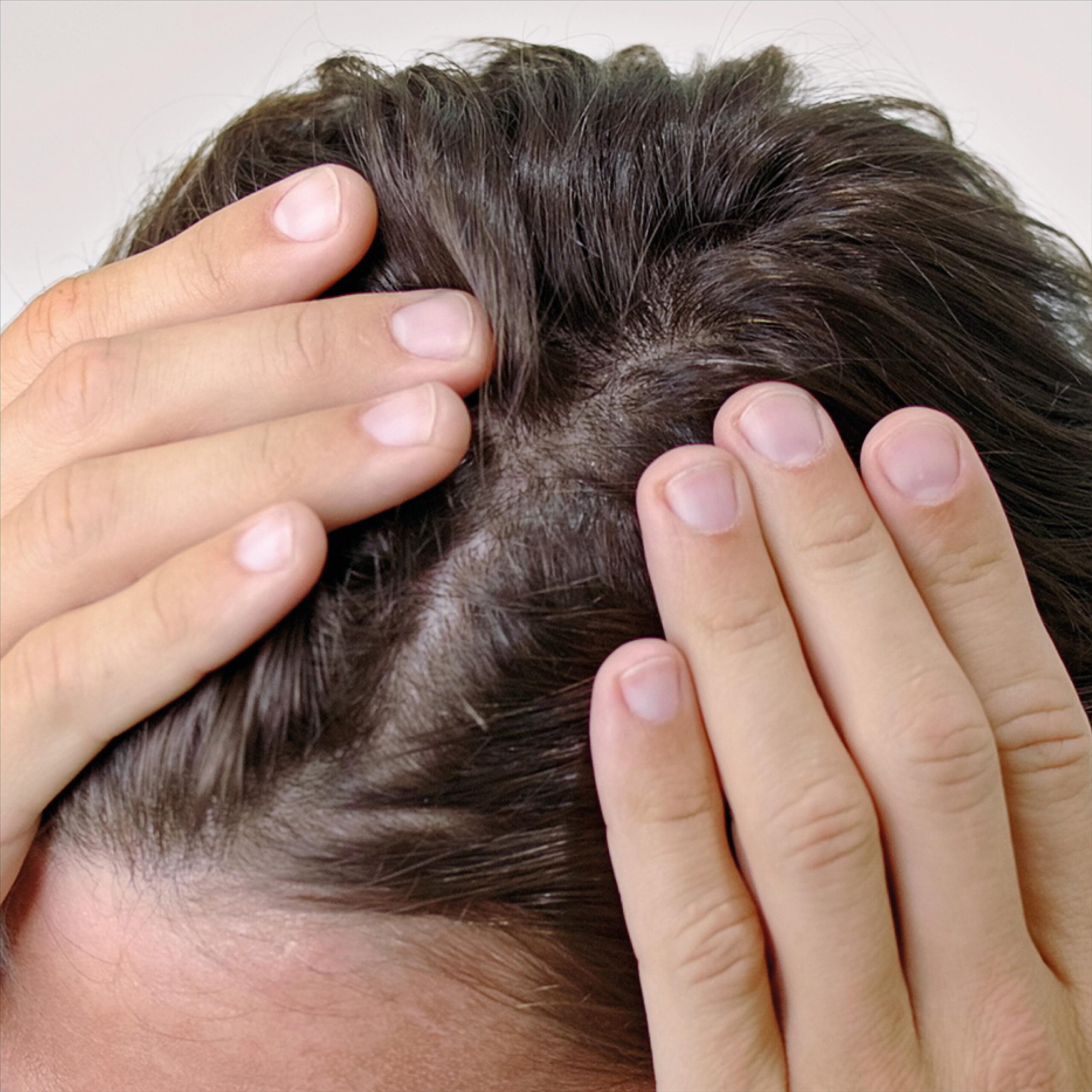 De Invloed van Hormonen op Haaruitval: Een Diepgaande Verkenning