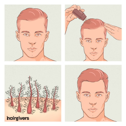 Effectieve Behandelingen voor Haaruitval en Kale Plekken: Herwin uw Haargroei!