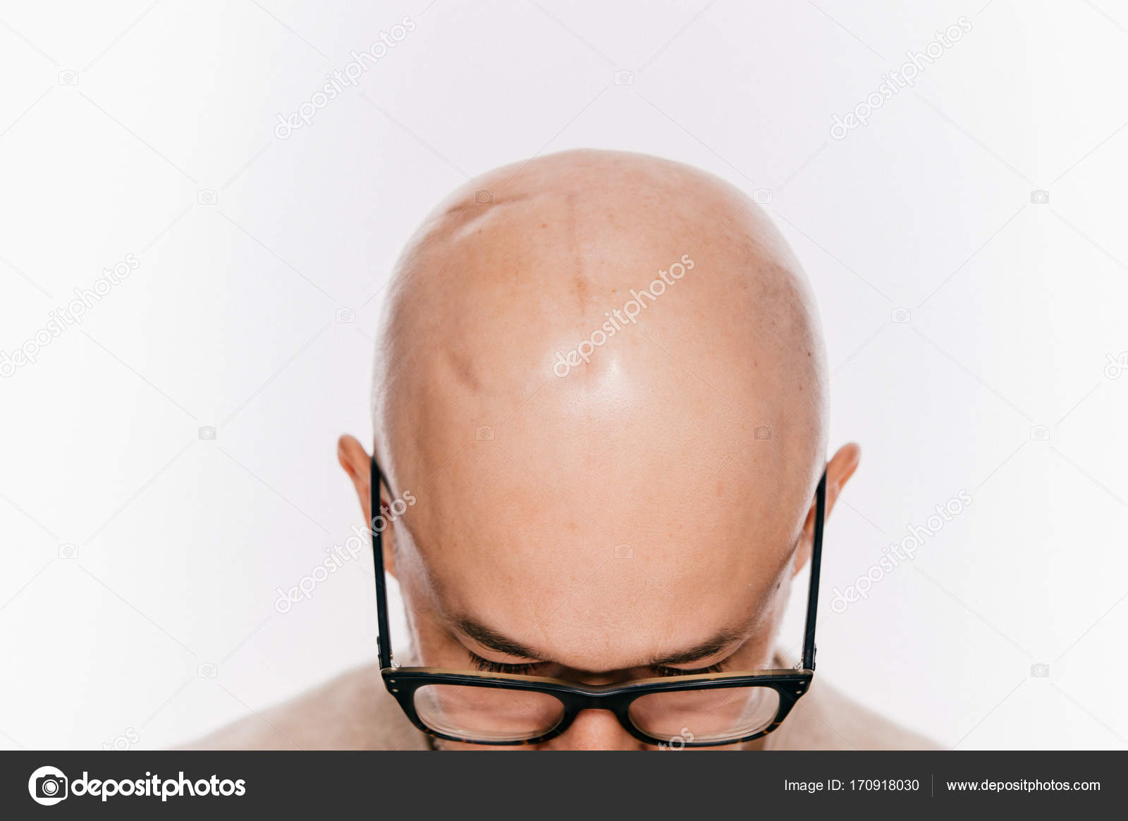 Haaruitval na bestraling van het hoofd: Oorzaken en Behandelingsopties