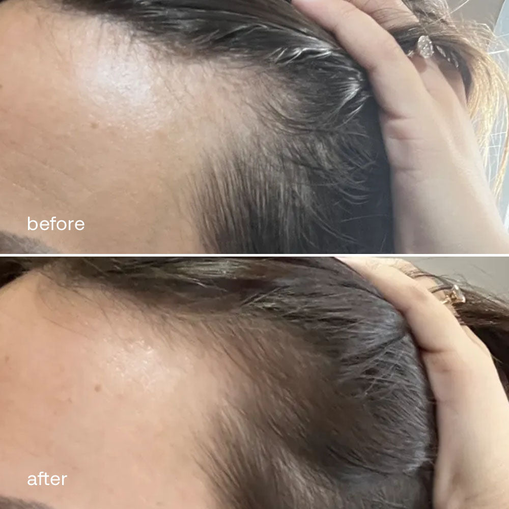 Tijdelijke haaruitval tijdens de overgang: een veelvoorkomend fenomeen