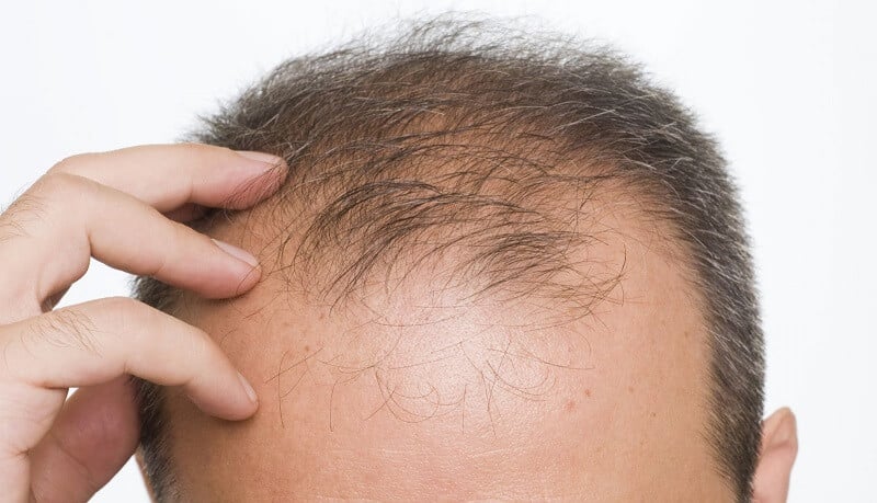 De Impact van Stress op Haarverlies: Feiten en Tips